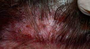 Фолікуліт - Які є типи фолікуліту шкіри голови?