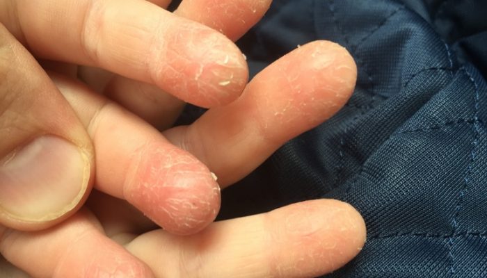 Лущення кінчиків пальців - Які причини лущення кінчиків пальців?