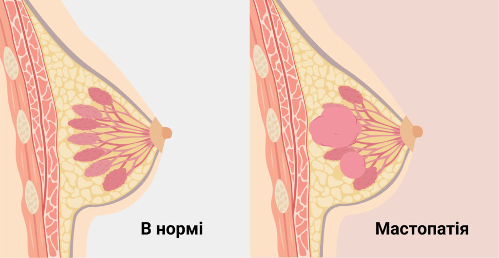 Мастопатія - Як позбутися мастопатії?