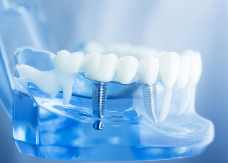 Імплантація зубів: етапи процедури
