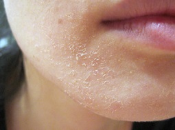 Обличчя - Які причини лущення шкіри на обличчі?