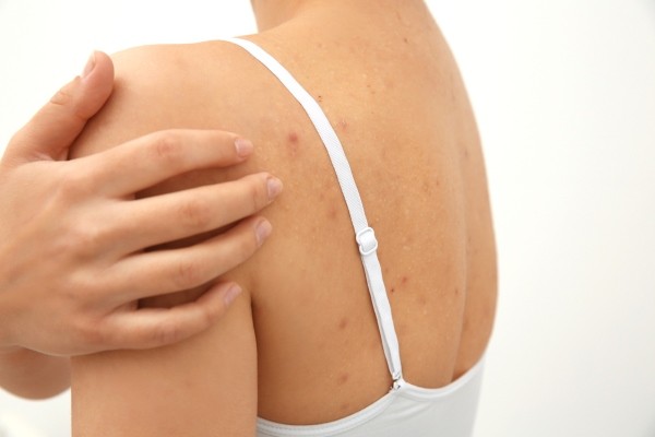 Прищі на спині - Які причини та способи лікування прищів на спині?