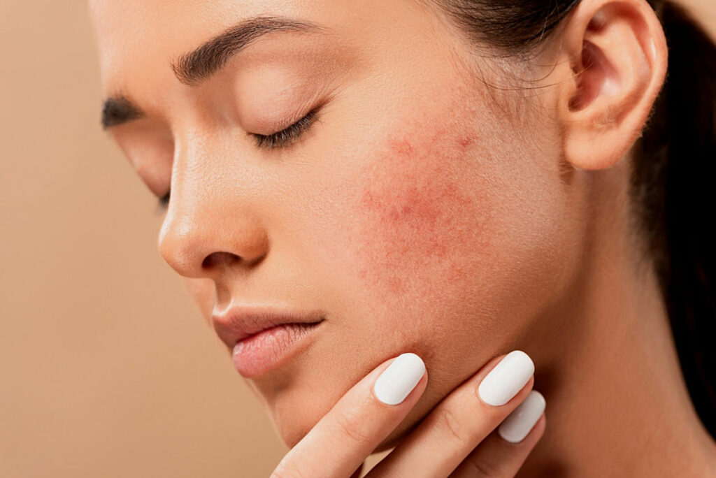 Шкіра - Як вибрати засіб для вмивання для проблемної шкіри?