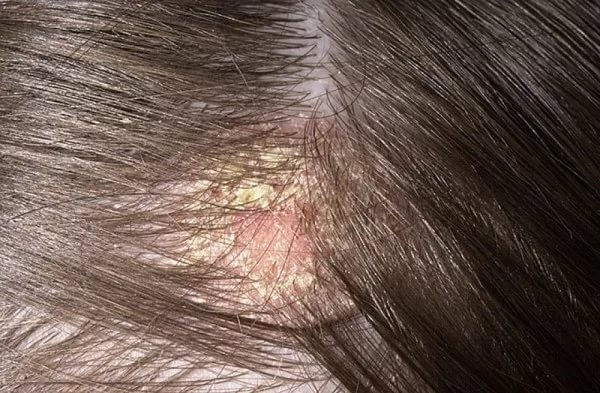 Струпи на шкірі голови - Які причини виникнення струпів на шкірі голови?