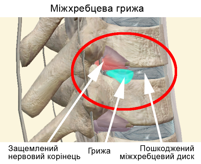 Звідки береться грижа хребта і що з нею робити